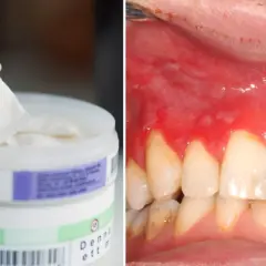 En hand tar en bit från en burk med snus. Till höger syns ett inflammerat tandkött, ett möjligt granit snus problem.
