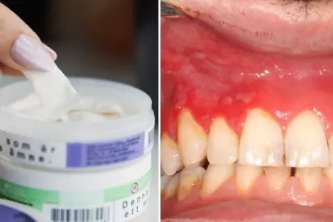 En hand tar en bit från en burk med snus. Till höger syns ett inflammerat tandkött, ett möjligt granit snus problem.