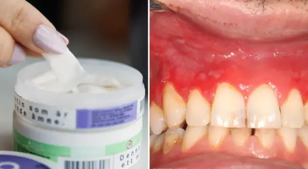 En hand tar en bit från en burk med snus. Till höger syns ett inflammerat tandkött, ett möjligt granit snus problem.