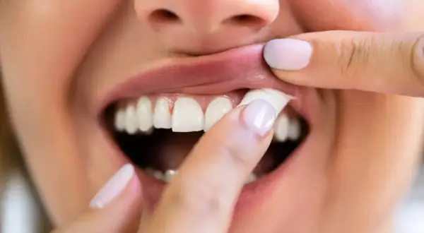 En person drar upp läppen och visar tänderna, en känsla av snus ångest.